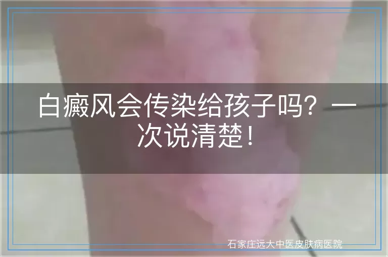 白癜风会传染给孩子吗？一次说清楚！