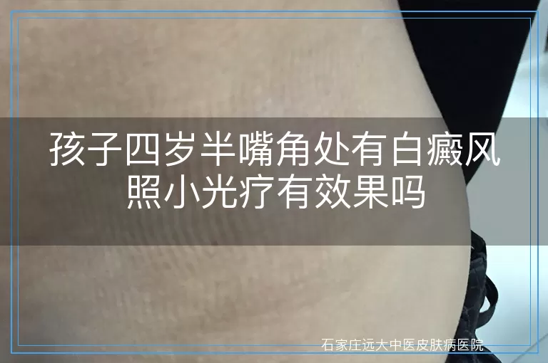 孩子四岁半嘴角处有白癜风照小光疗有效果吗