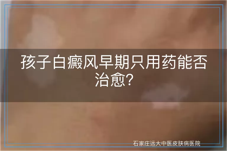 孩子白癜风早期只用药能否治愈？