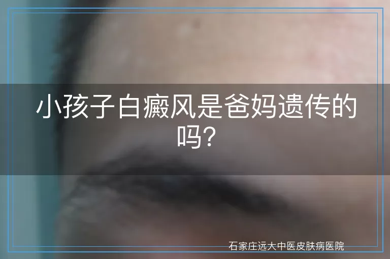 小孩子白癜风是爸妈遗传的吗？
