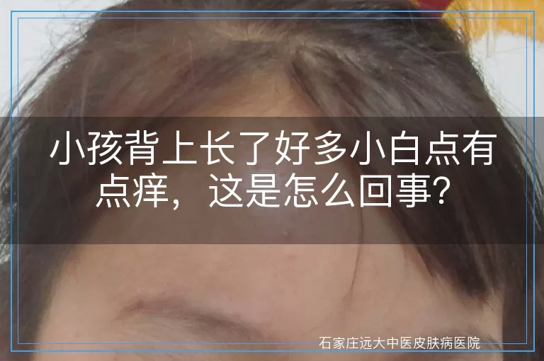 小孩背上长了好多小白点有点痒，这是怎么回事？