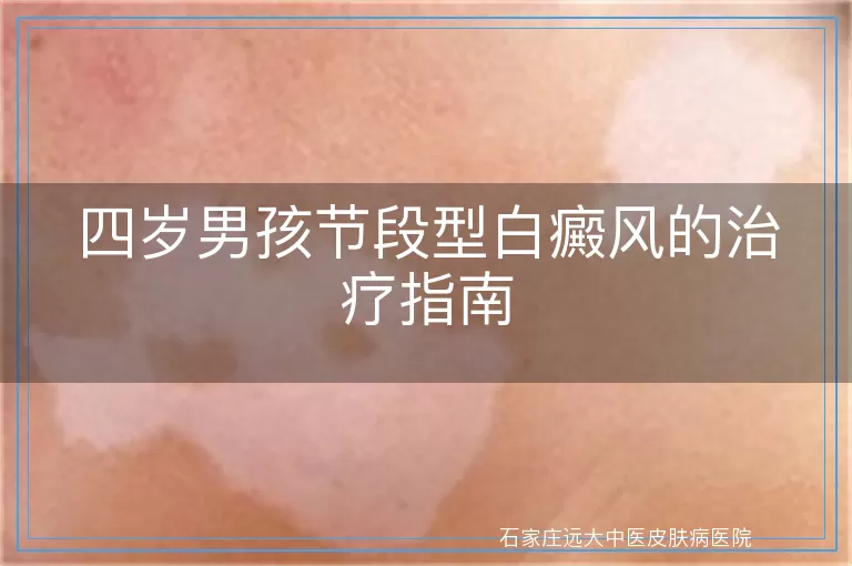 四岁男孩节段型白癜风的治疗指南