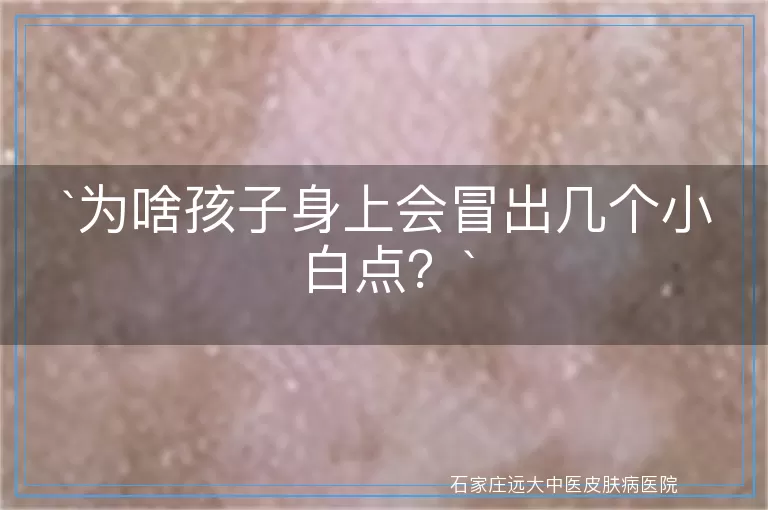为啥孩子身上会冒出几个小白点？