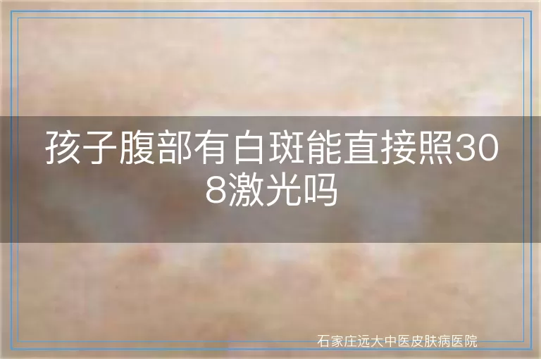 孩子腹部有白斑能直接照308激光吗
