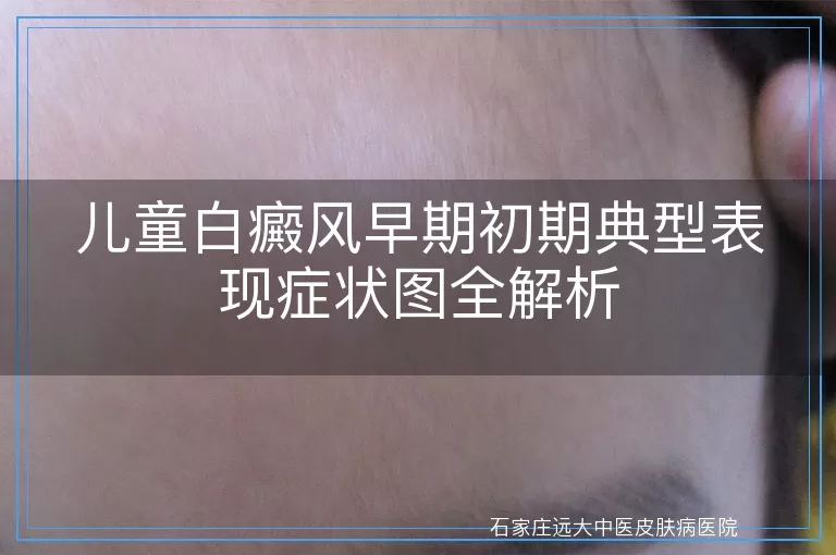 儿童白癜风早期初期典型表现症状图全解析