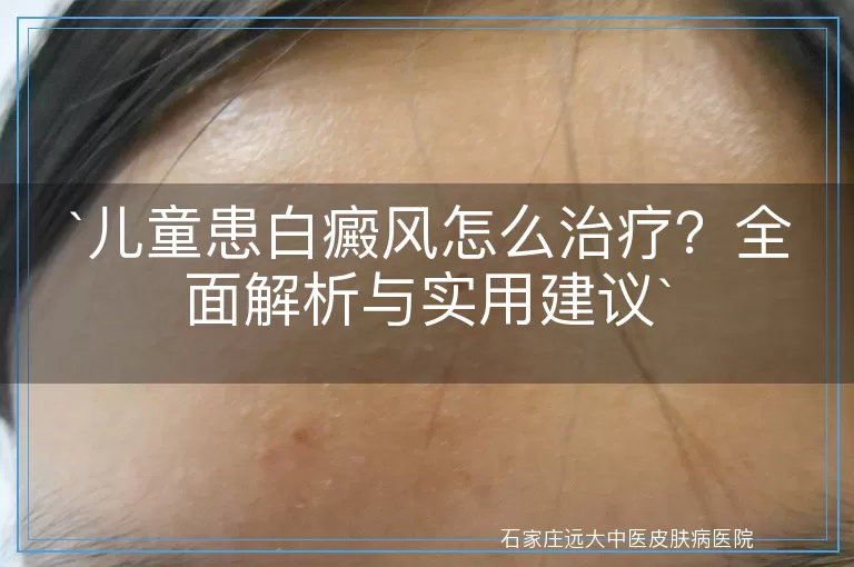 儿童患白癜风怎么治疗？全面解析与实用建议