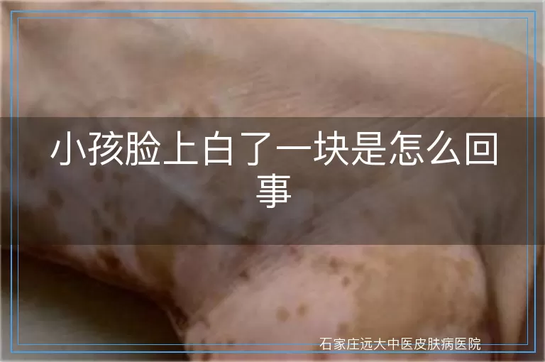 小孩脸上白了一块是怎么回事