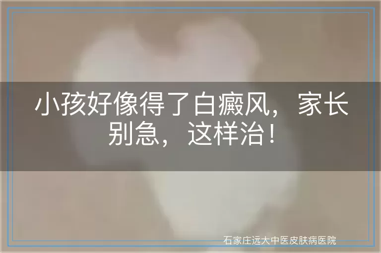 小孩好像得了白癜风，家长别急，这样治！
