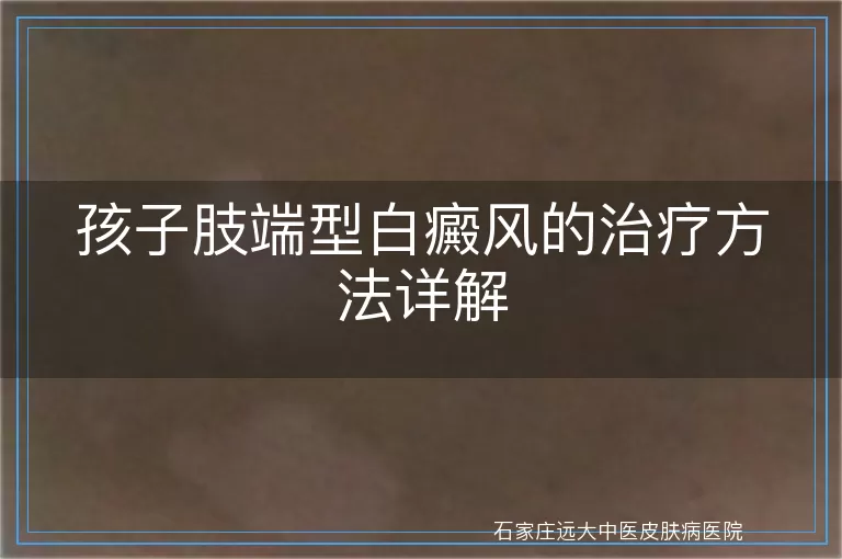 孩子肢端型白癜风的治疗方法详解