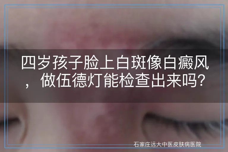 四岁孩子脸上白斑像白癜风，做伍德灯能检查出来吗？