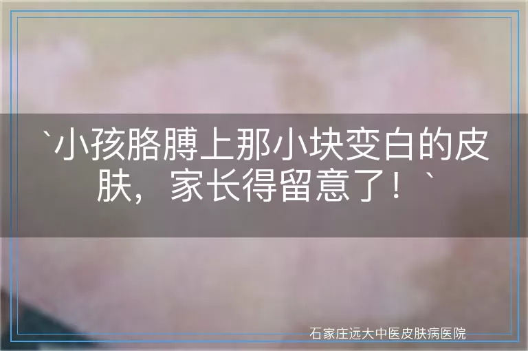 小孩胳膊上那小块变白的皮肤，家长得留意了！