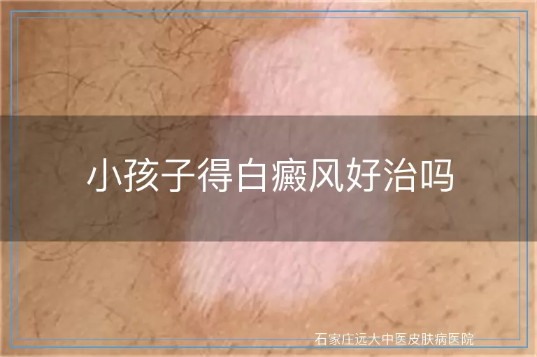 小孩子得白癜风好治吗