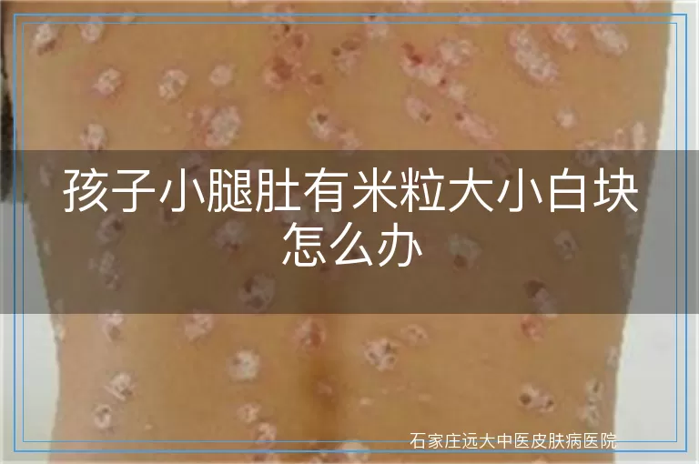 孩子小腿肚有米粒大小白块怎么办