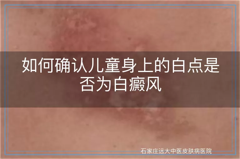 如何确认儿童身上的白点是否为白癜风