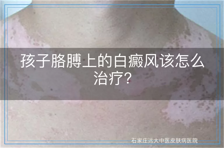 孩子胳膊上的白癜风该怎么治疗？