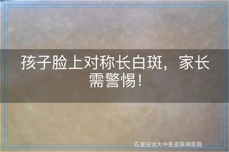 孩子脸上对称长白斑，家长需警惕！
