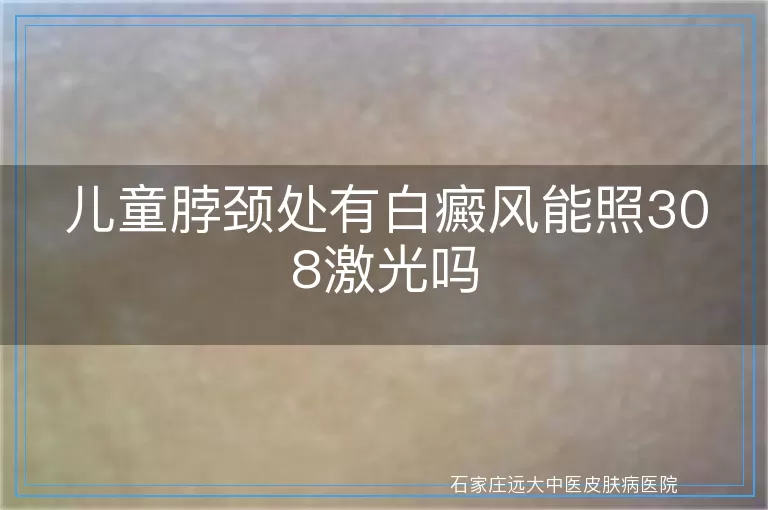 儿童脖颈处有白癜风能照308激光吗