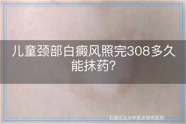 儿童颈部白癜风照完308多久能抹药？