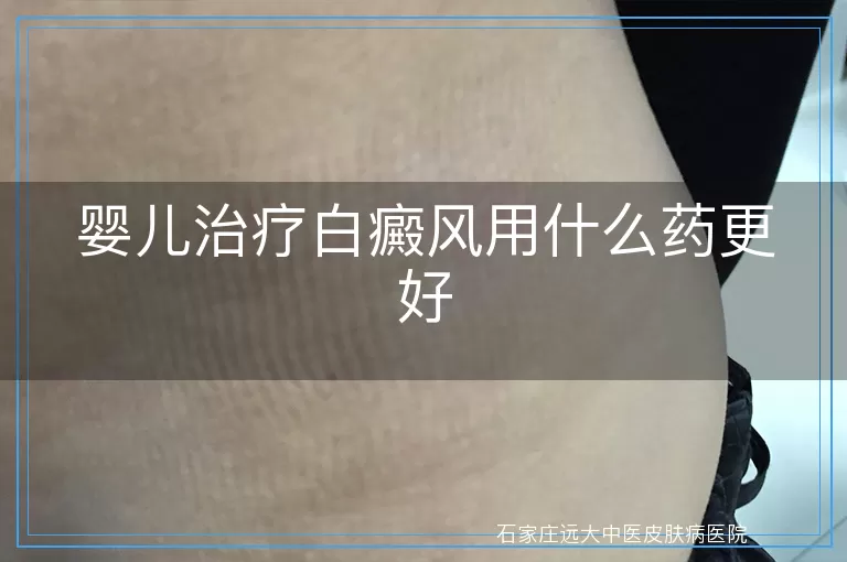 婴儿治疗白癜风用什么药更好