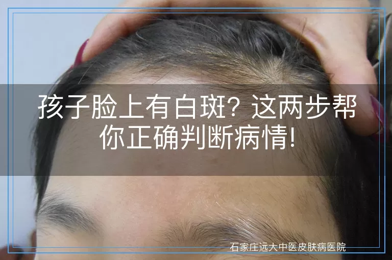孩子脸上有白斑? 这两步帮你正确判断病情!