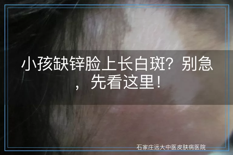 小孩缺锌脸上长白斑？别急，先看这里！