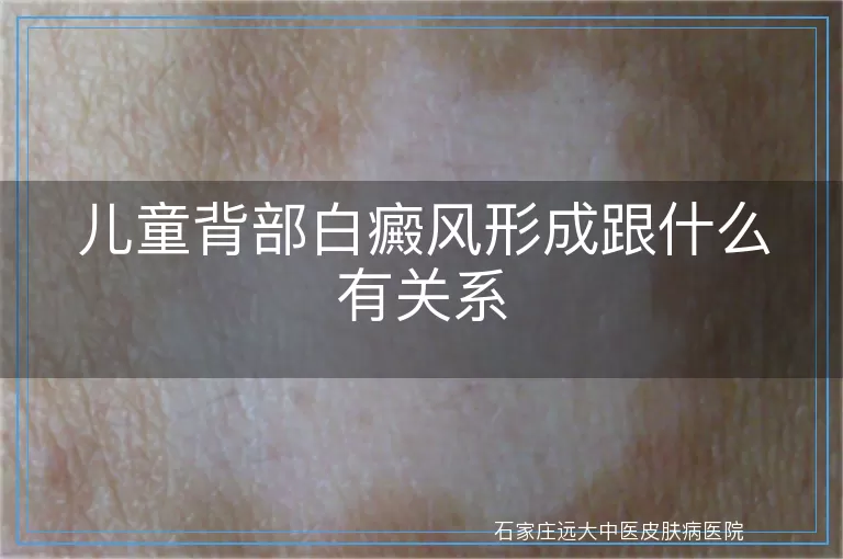 儿童背部白癜风形成跟什么有关系