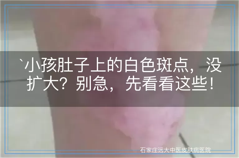 小孩肚子上的白色斑点，没扩大？别急，先看看这些！