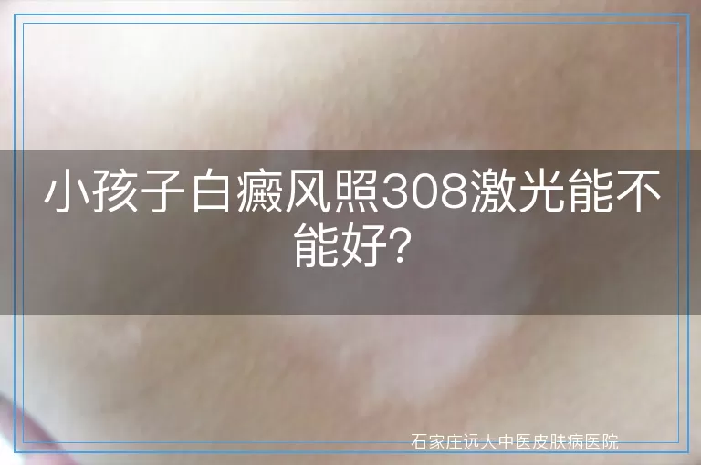 小孩子白癜风照308激光能不能好？
