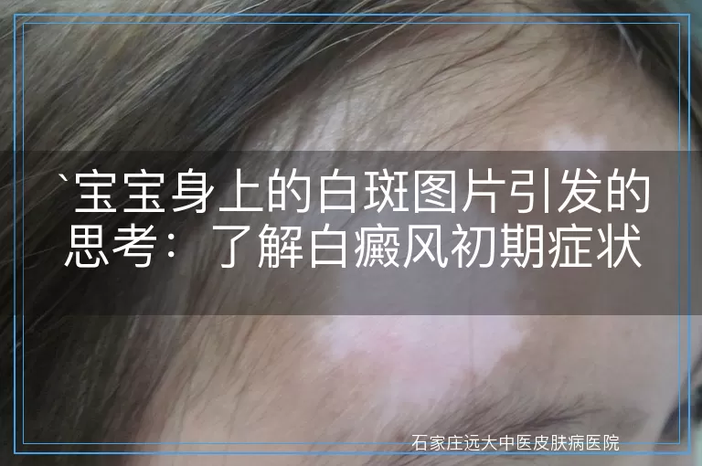 宝宝身上的白斑图片引发的思考：了解白癜风初期症状