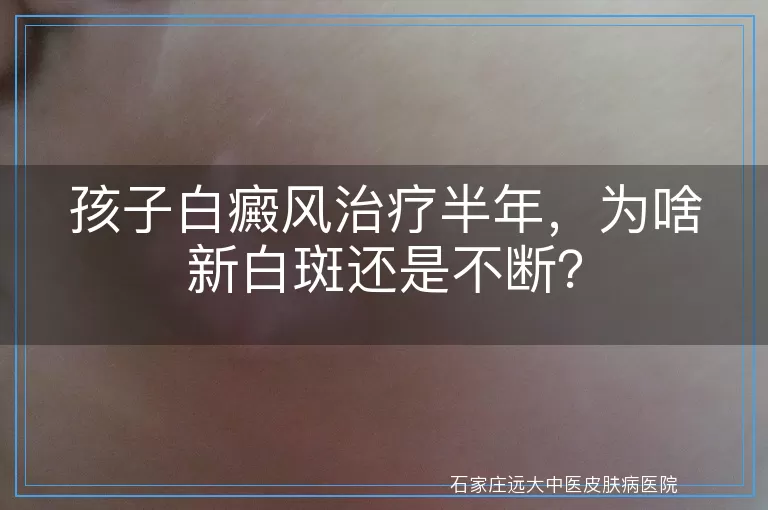 孩子白癜风治疗半年，为啥新白斑还是不断？