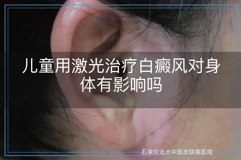 儿童用激光治疗白癜风对身体有影响吗