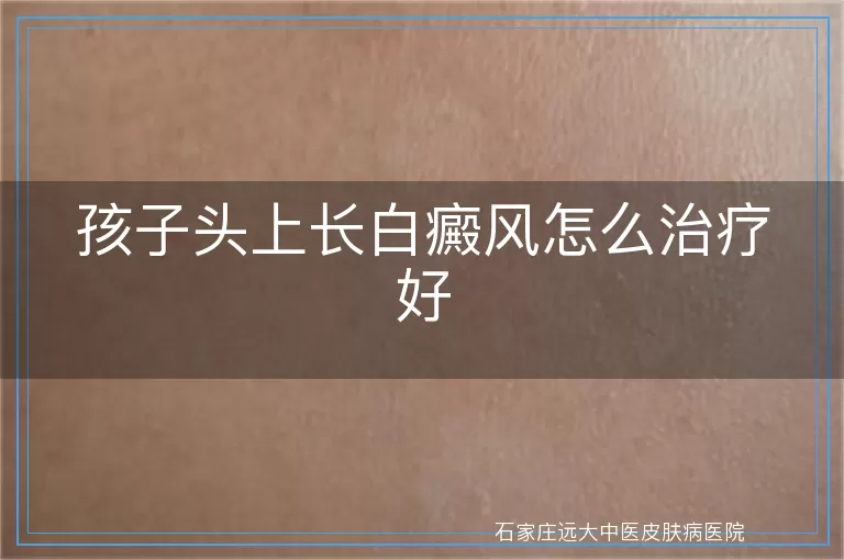 孩子头上长白癜风怎么治疗好