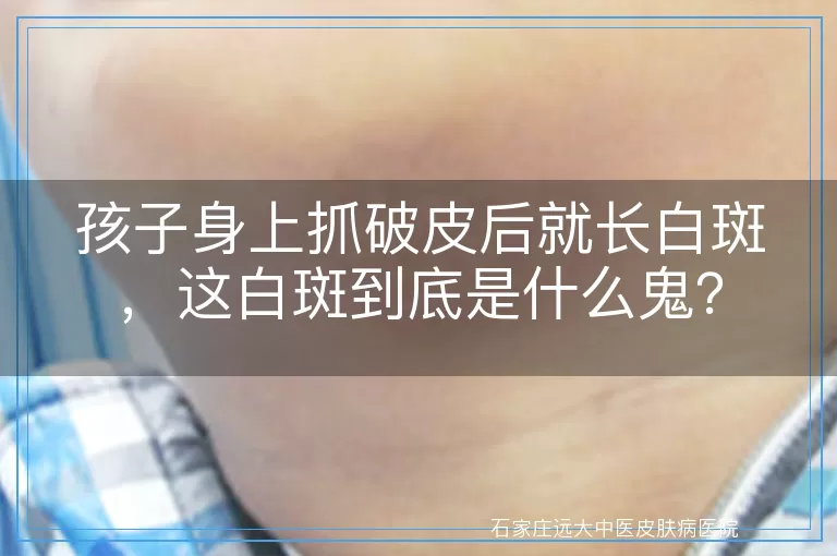 孩子身上抓破皮后就长白斑，这白斑到底是什么鬼？