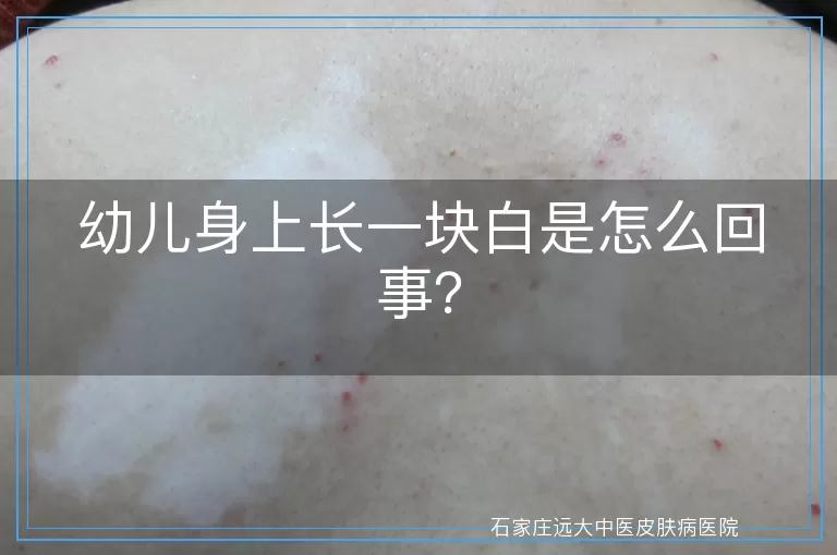幼儿身上长一块白是怎么回事？