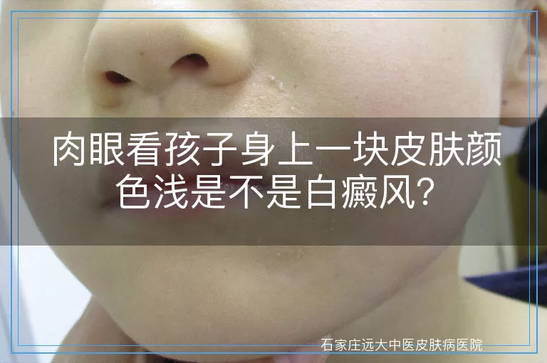 肉眼看孩子身上一块皮肤颜色浅是不是白癜风？