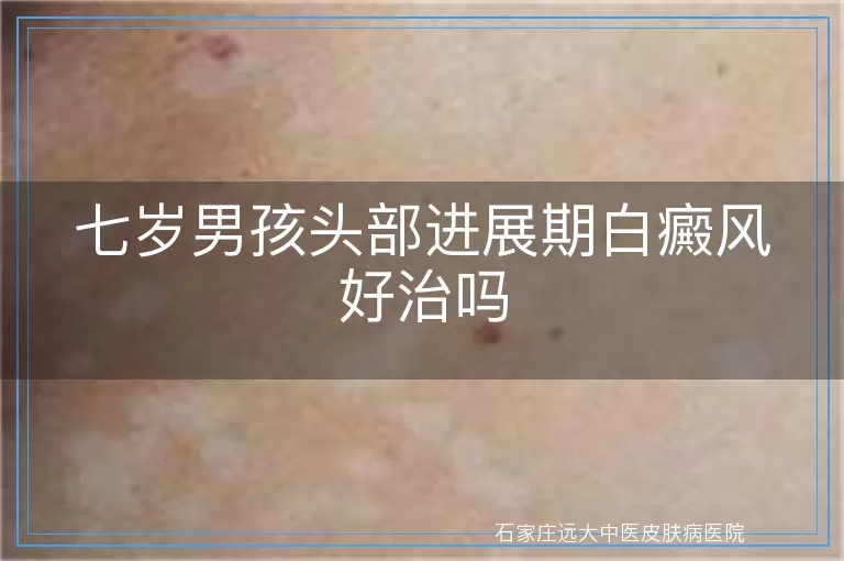 七岁男孩头部进展期白癜风好治吗