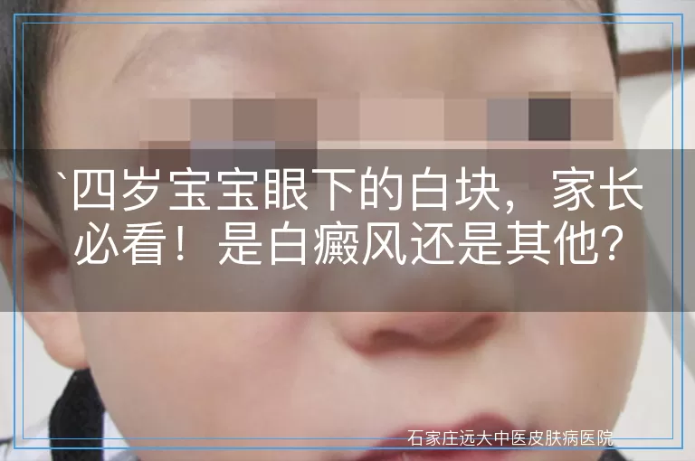 四岁宝宝眼下的白块，家长必看！是白癜风还是其他？