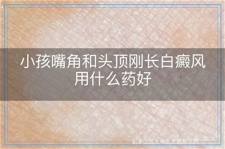 小孩嘴角和头顶刚长白癜风用什么药好
