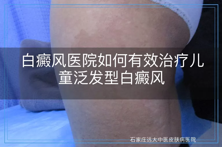 白癜风医院如何有效治疗儿童泛发型白癜风