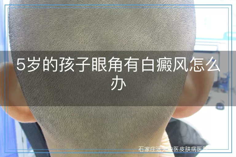 5岁的孩子眼角有白癜风怎么办