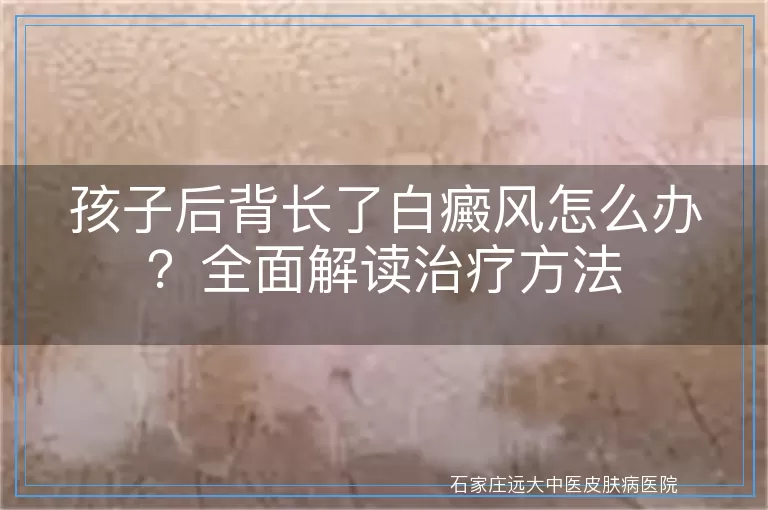 孩子后背长了白癜风怎么办？全面解读治疗方法