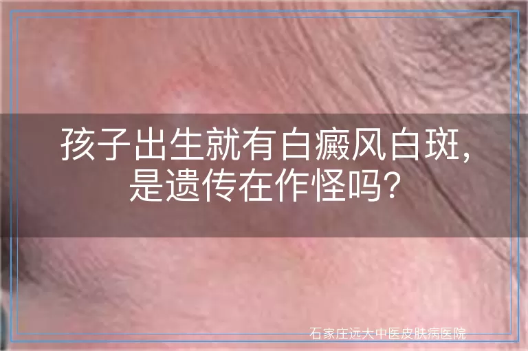 孩子出生就有白癜风白斑，是遗传在作怪吗？