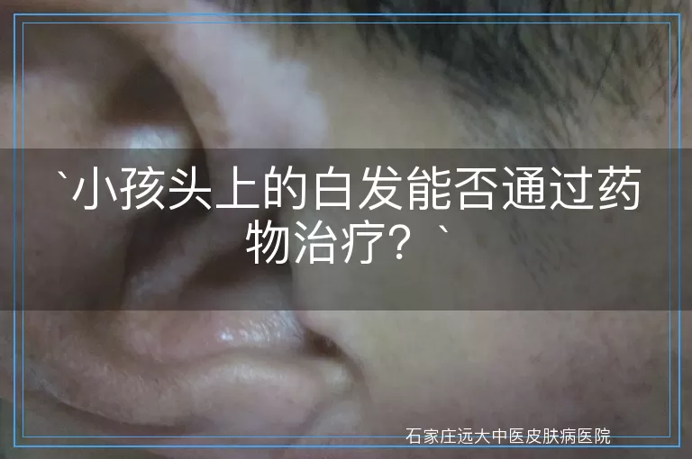 小孩头上的白发能否通过药物治疗？