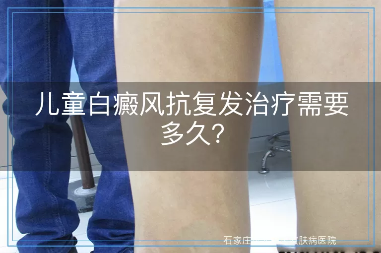 儿童白癜风抗复发治疗需要多久？