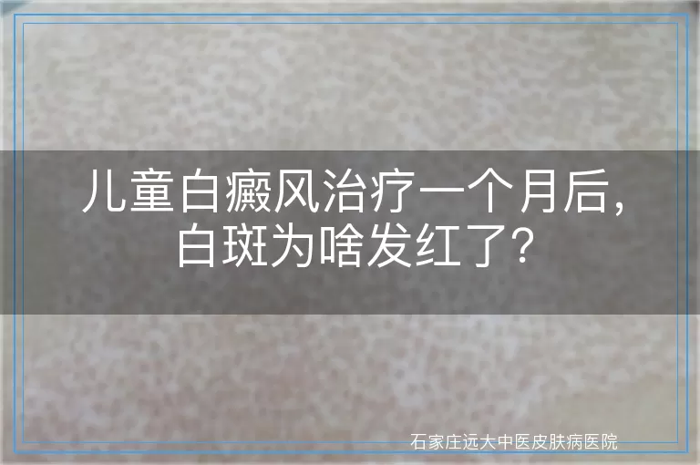 儿童白癜风治疗一个月后，白斑为啥发红了？