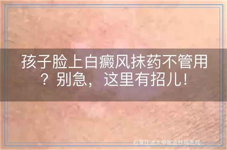 孩子脸上白癜风抹药不管用？别急，这里有招儿！