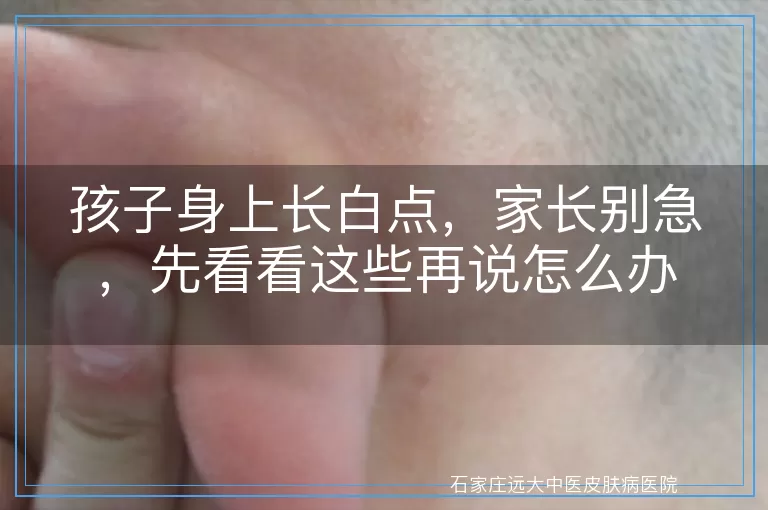 孩子身上长白点，家长别急，先看看这些再说怎么办
