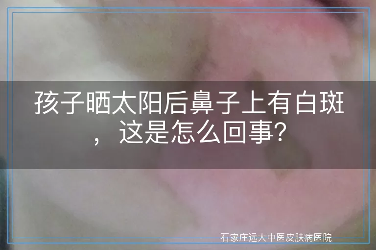 孩子晒太阳后鼻子上有白斑，这是怎么回事？