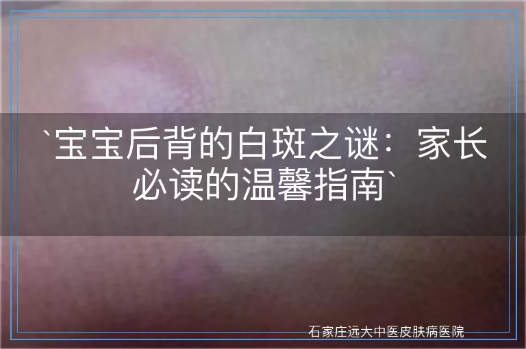 宝宝后背的白斑之谜：家长必读的温馨指南