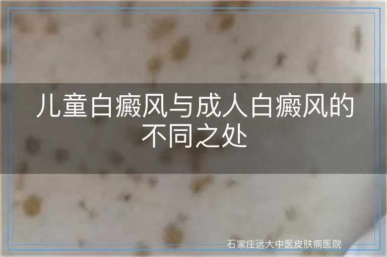 儿童白癜风与成人白癜风的不同之处